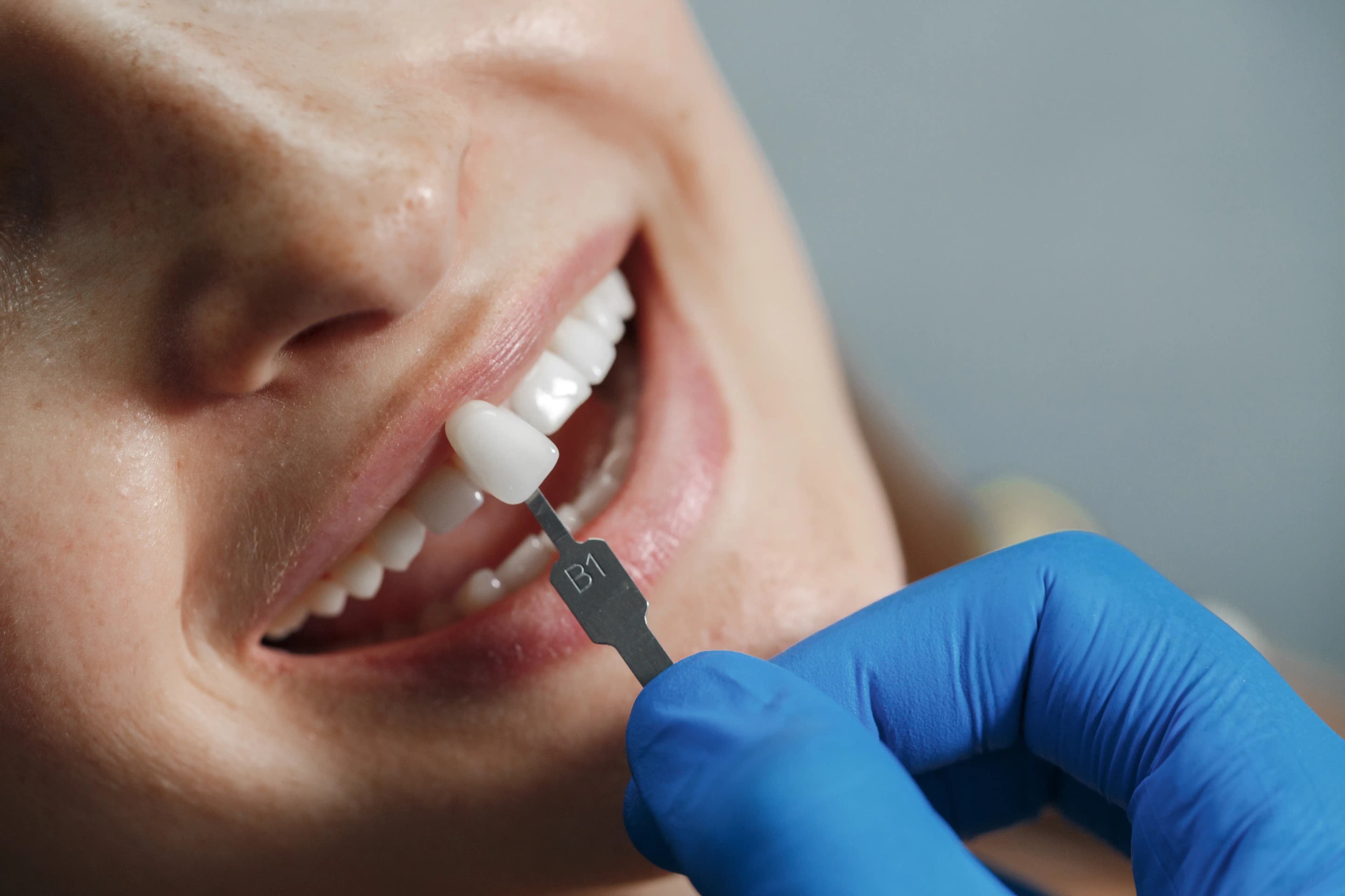 Ottawa Dental Centre Porcelain Veneers in Ottawa